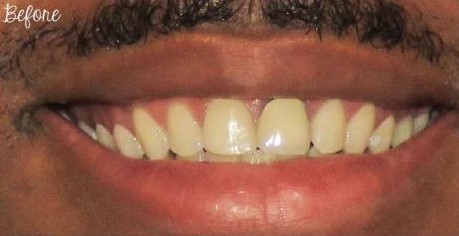 Before