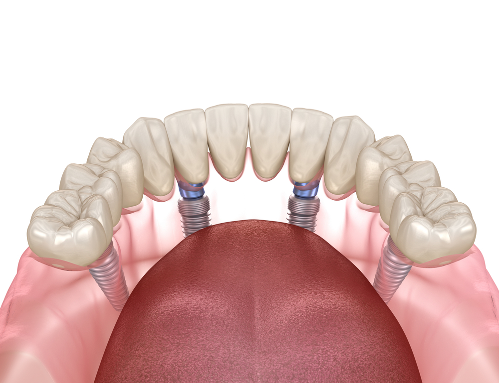 All-On-X Implants